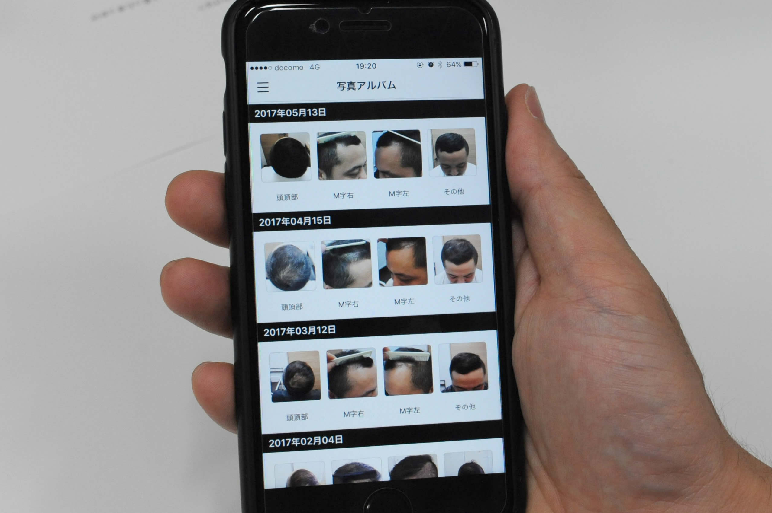 薄毛治療の体験談、アプリ画像