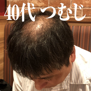 40代の頭頂部 つむじの薄毛は薄毛治療で治る 薄毛治療 Agaなら薄毛からの生還